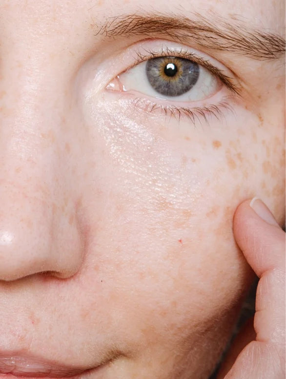 Close-up of a person's eye with visible freckles on the skin.